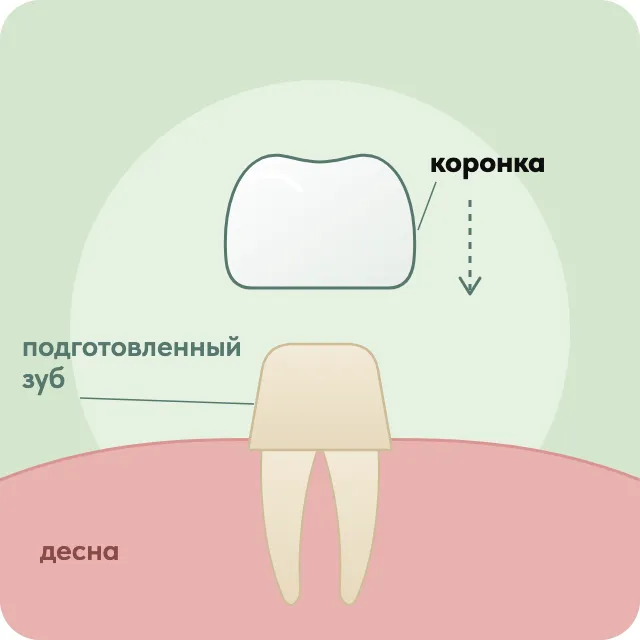 Схема: коронка надевается на подготовленный зуб